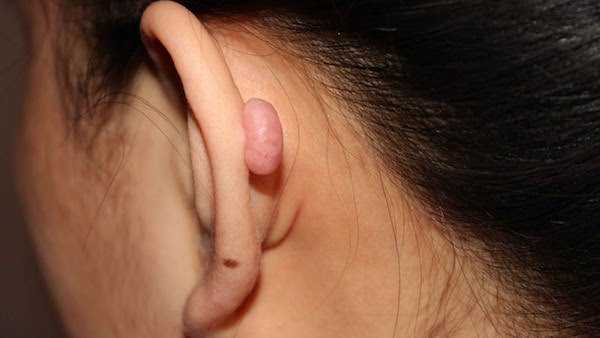 Болят уши от сережек после родов thumbnail